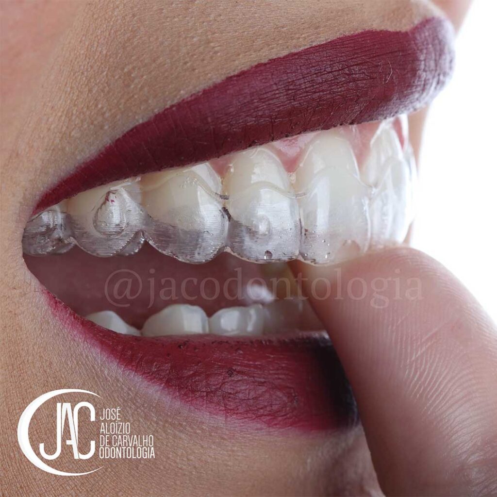 Invisalign em Belo Horizonte